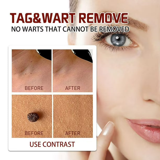 Lápiz líquido para eliminar verrugas genitales Wipeoff Tags & Moles Remover, 3 ml