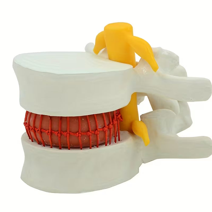 1pc Modelo De Hernia De Disco Intervertebral De Demostración Simulador Vertebral Columna