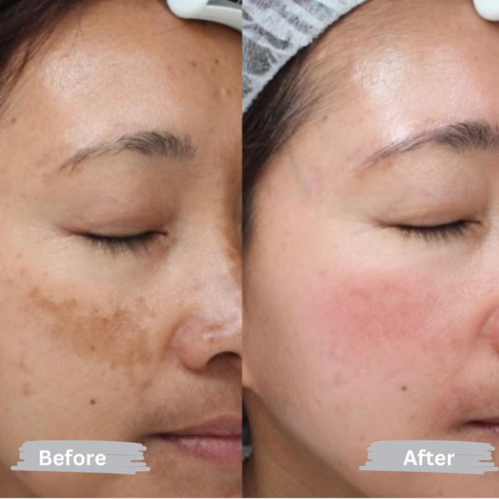 Anyi Beauty Eliminador de manchas oscuras para rostro y cuerpo, crema blanqueadora facial