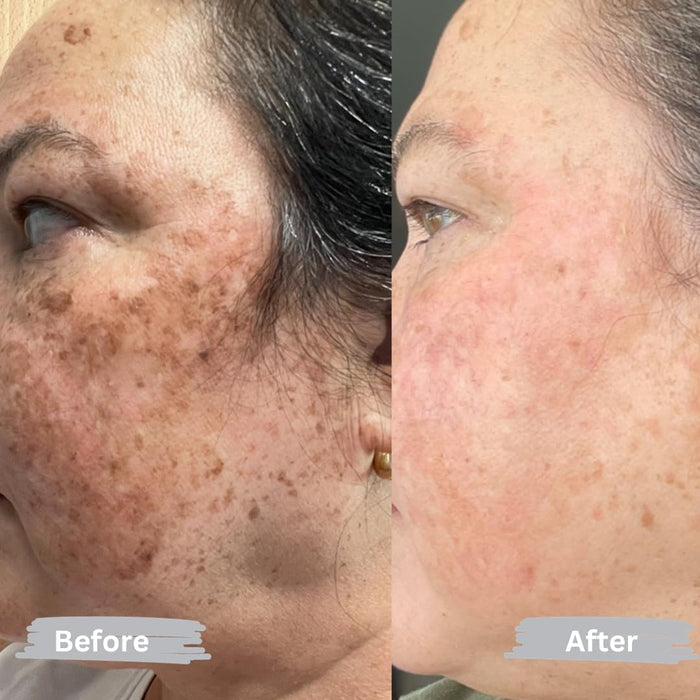 Anyi Beauty Eliminador de manchas oscuras para rostro y cuerpo, crema blanqueadora facial