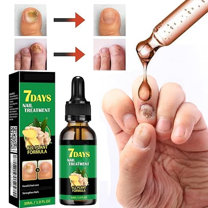 3Pcs de JAYSUING 30ml Extracto de jengibre Tratamiento para hongos en las uñas