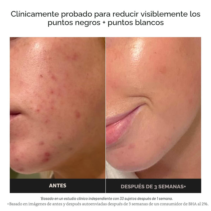 Paula's Choice Exfoliante líquido con 2 % de BHA para perfeccionar la piel