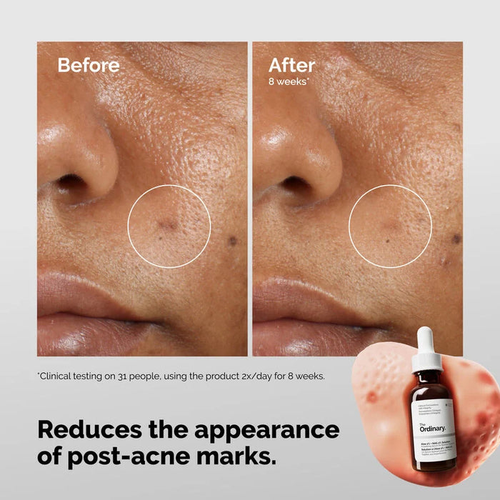 The Ordinary Solución de Aloe 2% + NAG 2%