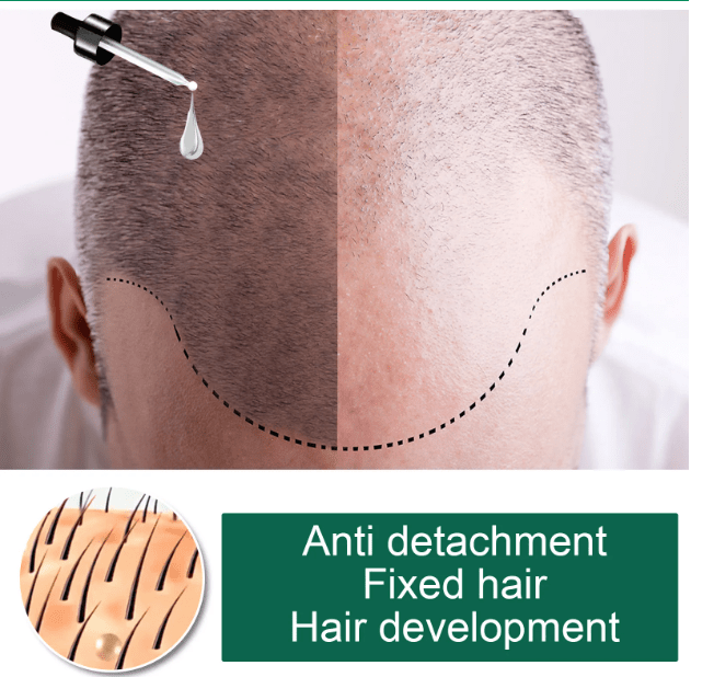 Aceite esencial para el cabello de crecimiento rápido y efectivo, 5 días de jengibre - Quierox - Tienda Online