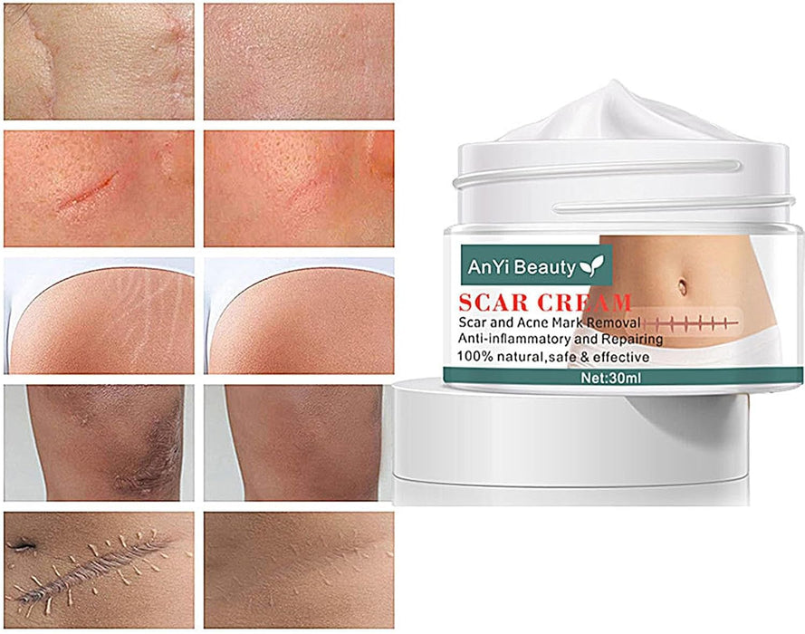 Anyi Beauty Crema para eliminar cicatrices - Quierox - Tienda Online