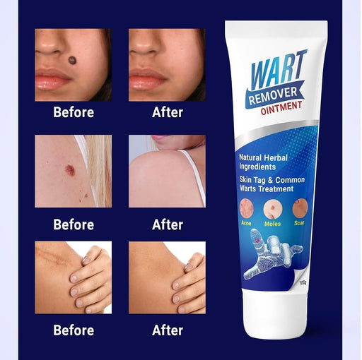 Crema para eliminar verrugas faciales (100 g) - Quierox - Tienda Online