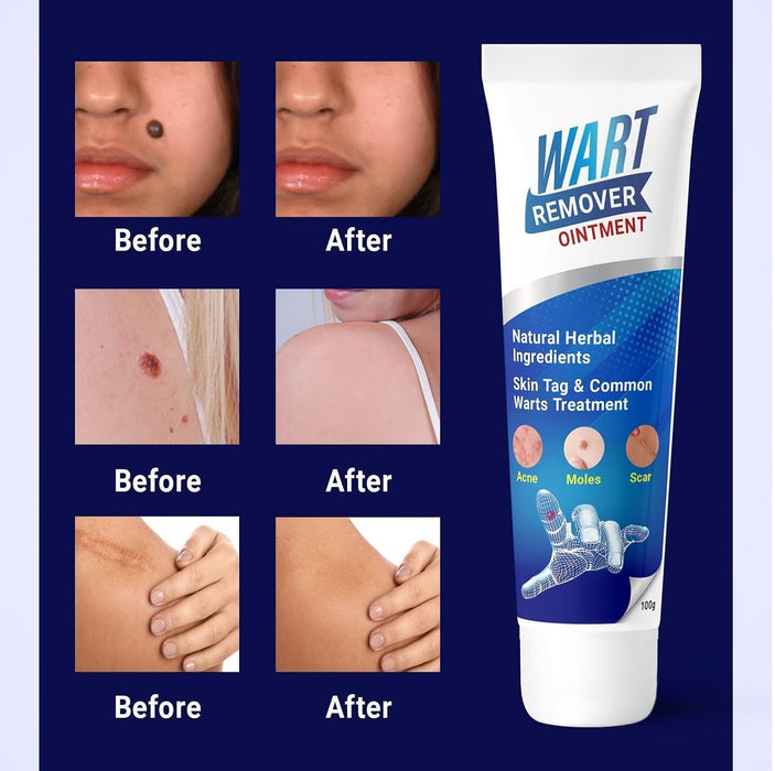 Crema para eliminar verrugas faciales (100 g) - Quierox - Tienda Online