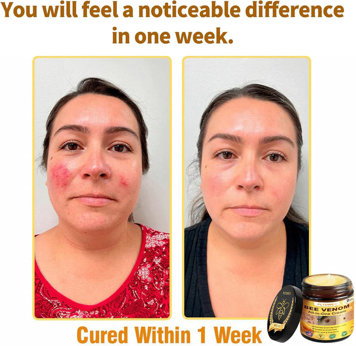 Crema todo en uno Pltowe con veneno de abeja, crema para el tratamiento de la piel - Quierox - Tienda Online