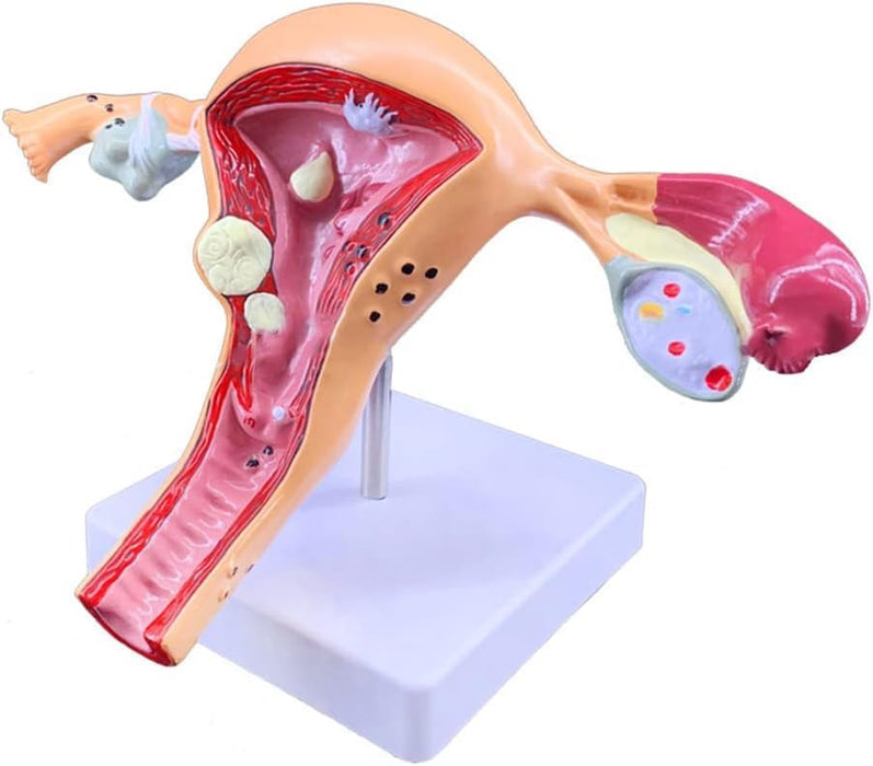 Modelo anatómico de patología de ovario de útero - Quierox - Tienda Online