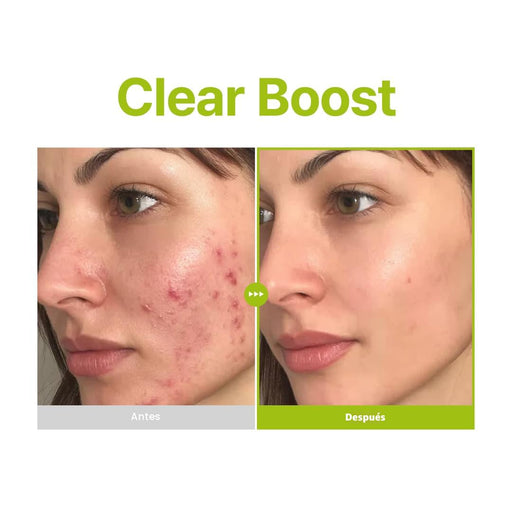 PURITO Ácido Azelaico 10% + Ácido Kójico + Suero Facial de Árbol de Té - Quierox - Tienda Online