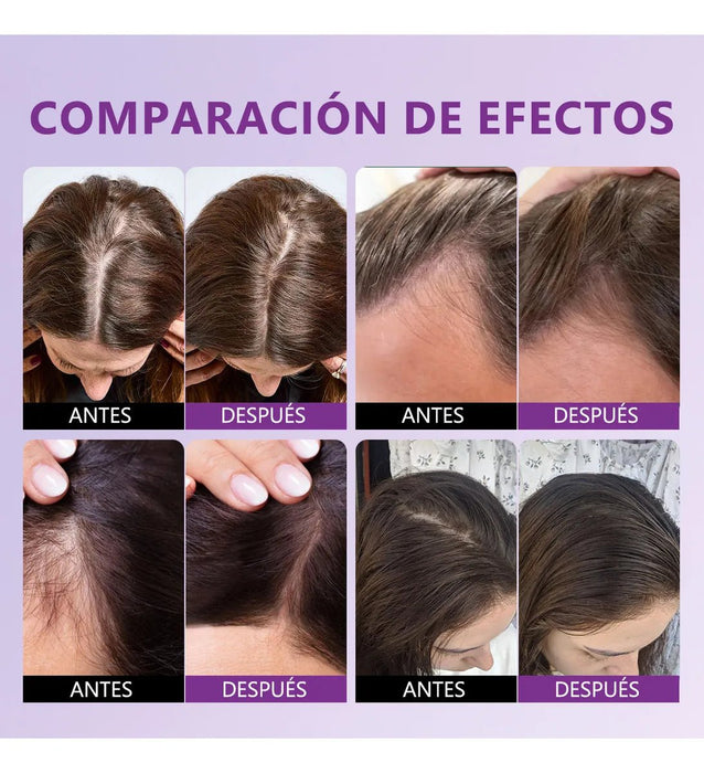 Spray Minoxidil 5% Crecimiento Sérum Para Cabello Y Barba - Quierox - Tienda Online