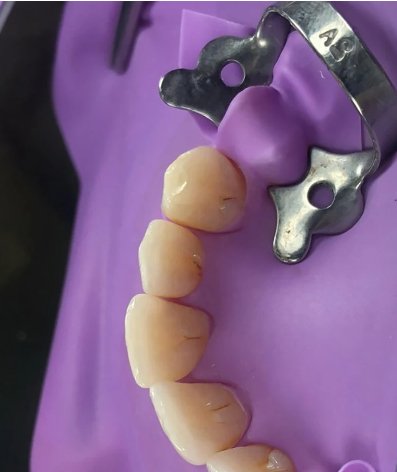 Abrazaderas de dique de goma Dental - Quierox - Tienda Online